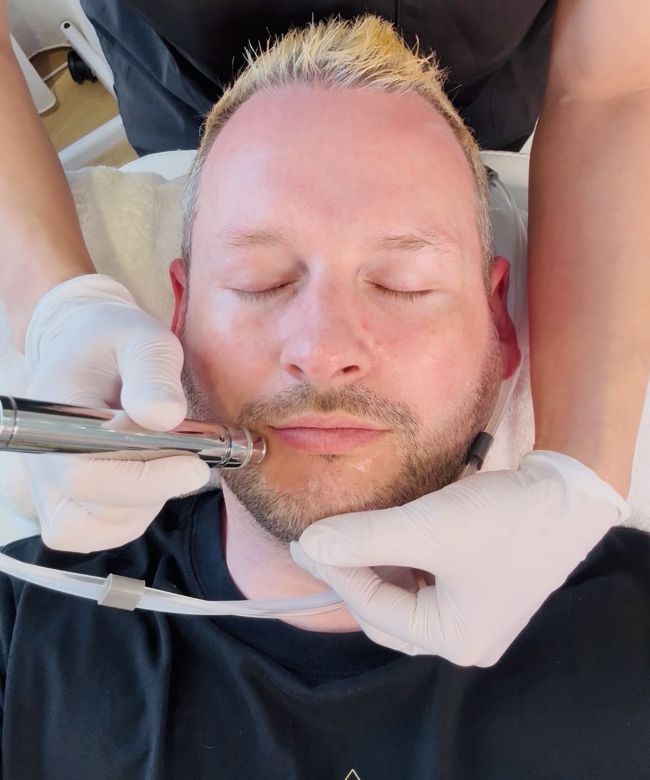 Microneedling pen being used on a client's face