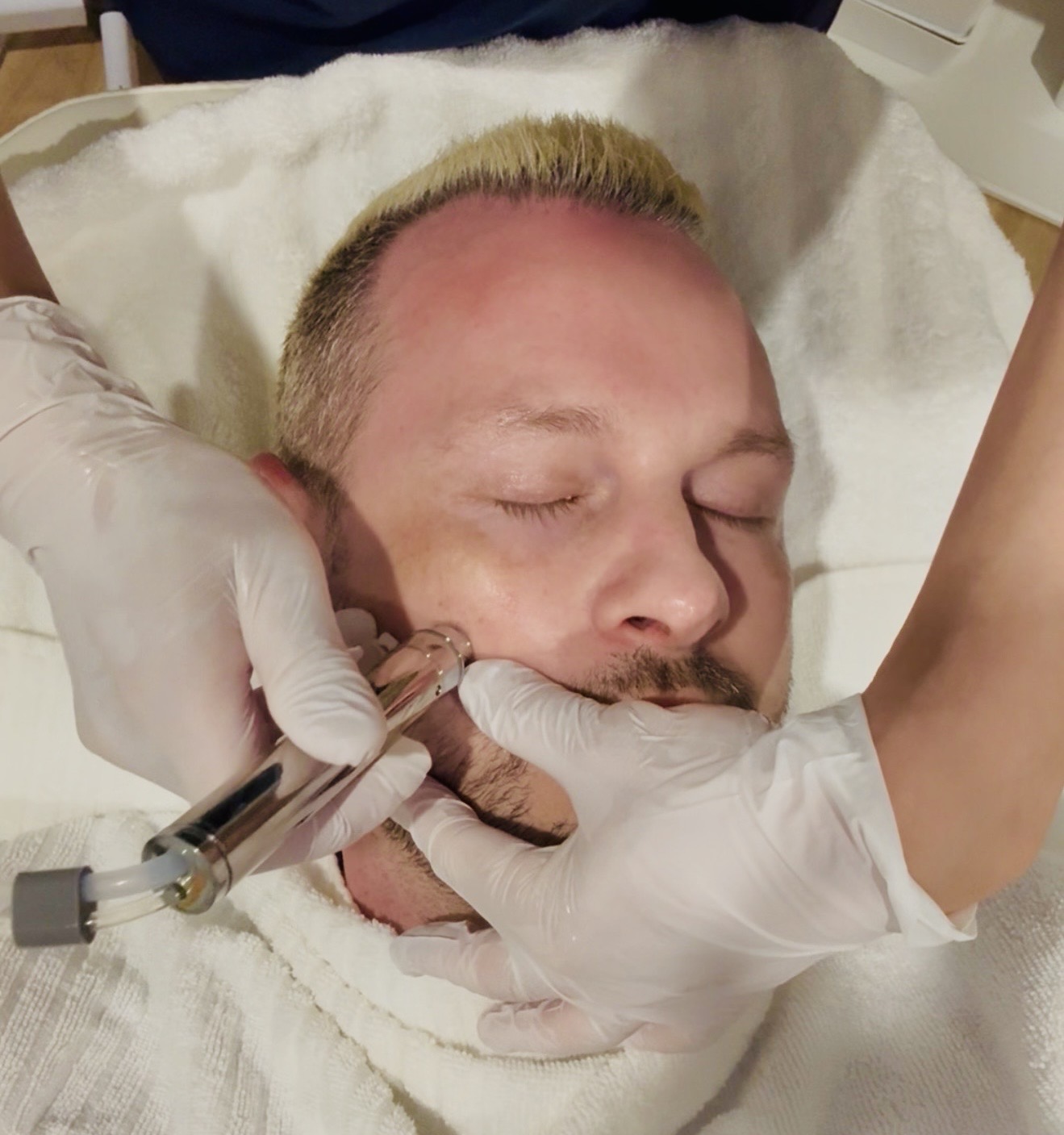 A detailed view of the microneedling process on facial skin