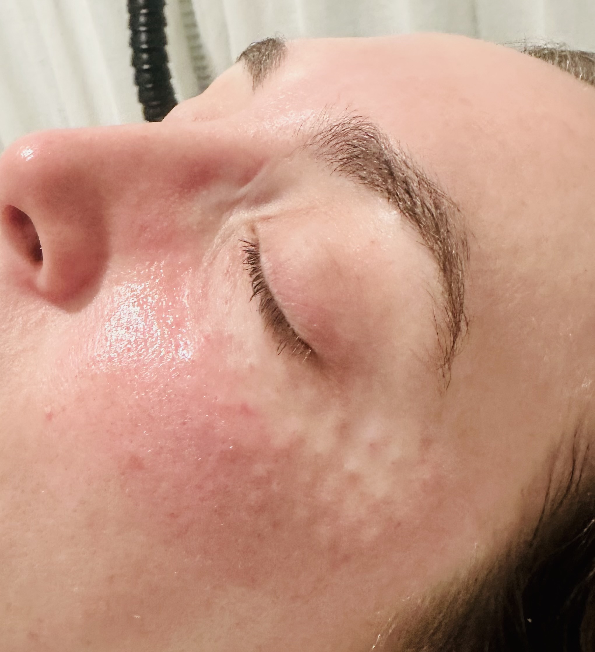 Microneedling pen being used on a client's face