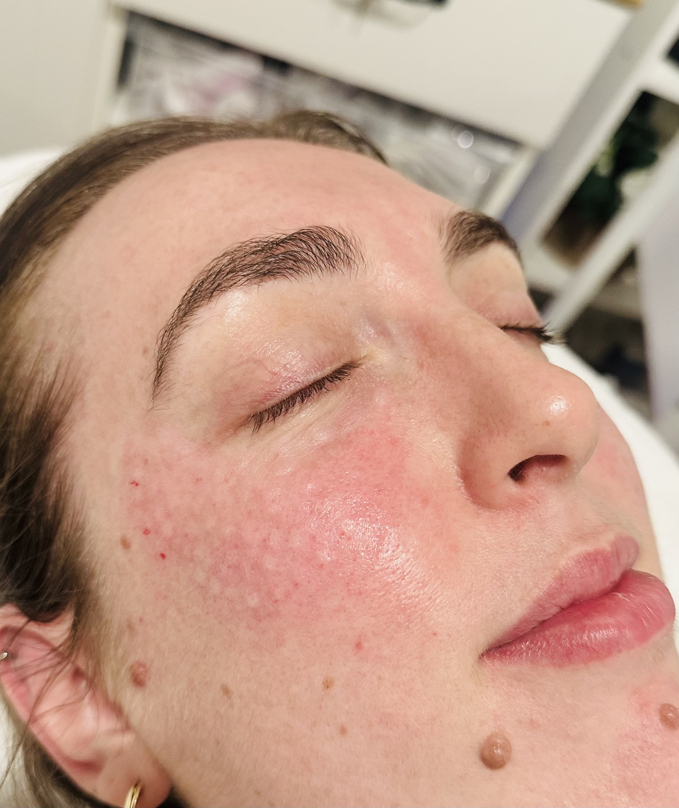 Close-up of microneedling pen device on skin