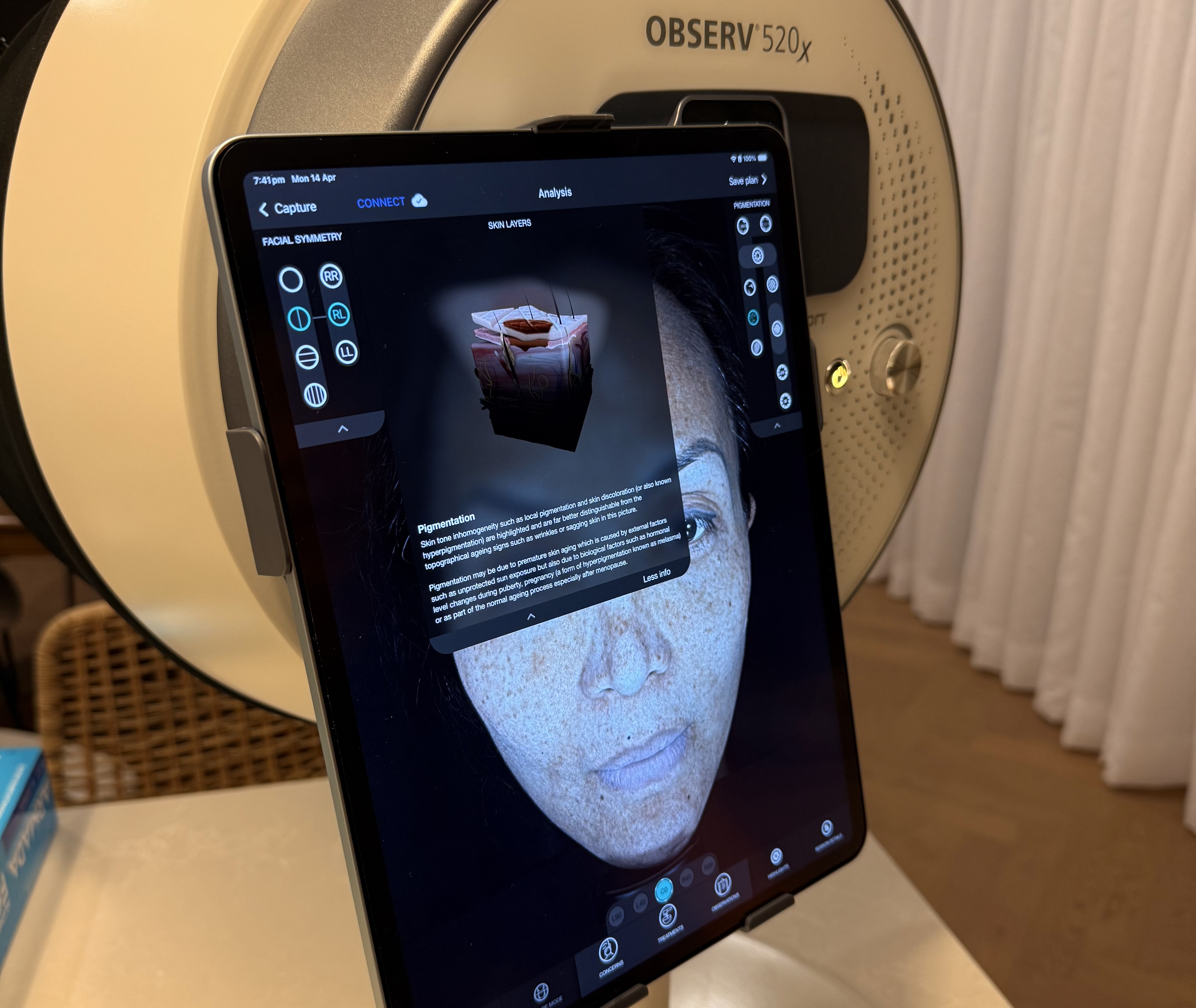 A detailed view of the microneedling process on facial skin